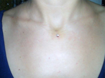 Microdermal